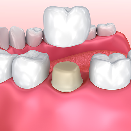 Benefits of Dental Crown