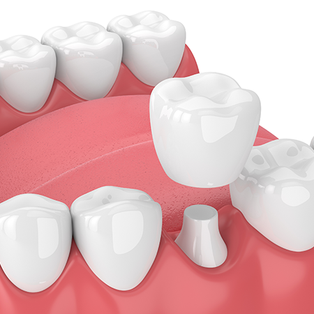 Dental Crown Procedure
