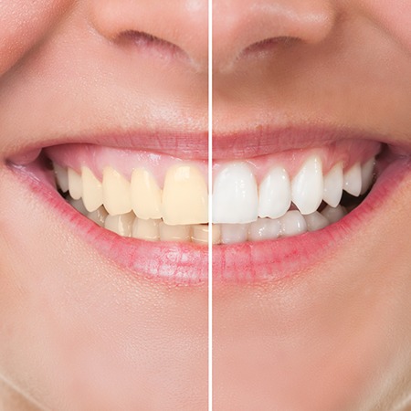 Before & After teeth Whitening