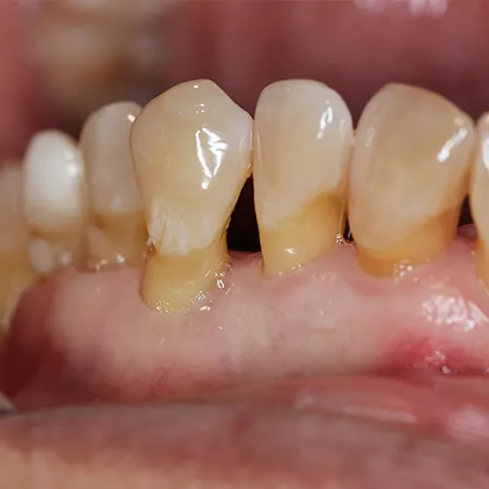 Causes of Missing Teeth