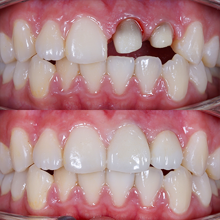 Dental Crowns before and after