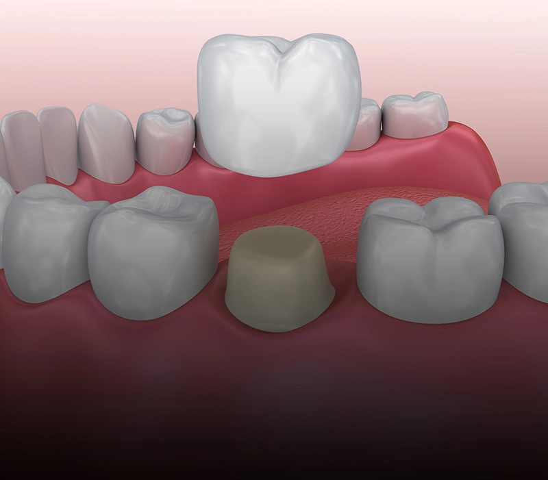 dental crown (5)
